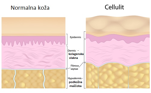normalna koža vs celulit